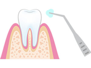 軽度の虫歯治療