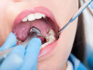 中程度の虫歯治療