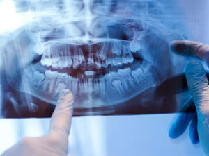 重度の虫歯治療