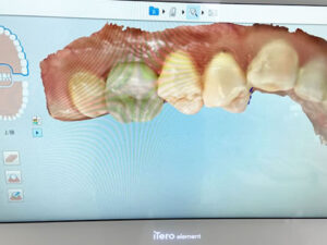 AIによる歯の移動シミュレーション
