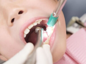 乳歯の虫歯はしっかり治療を