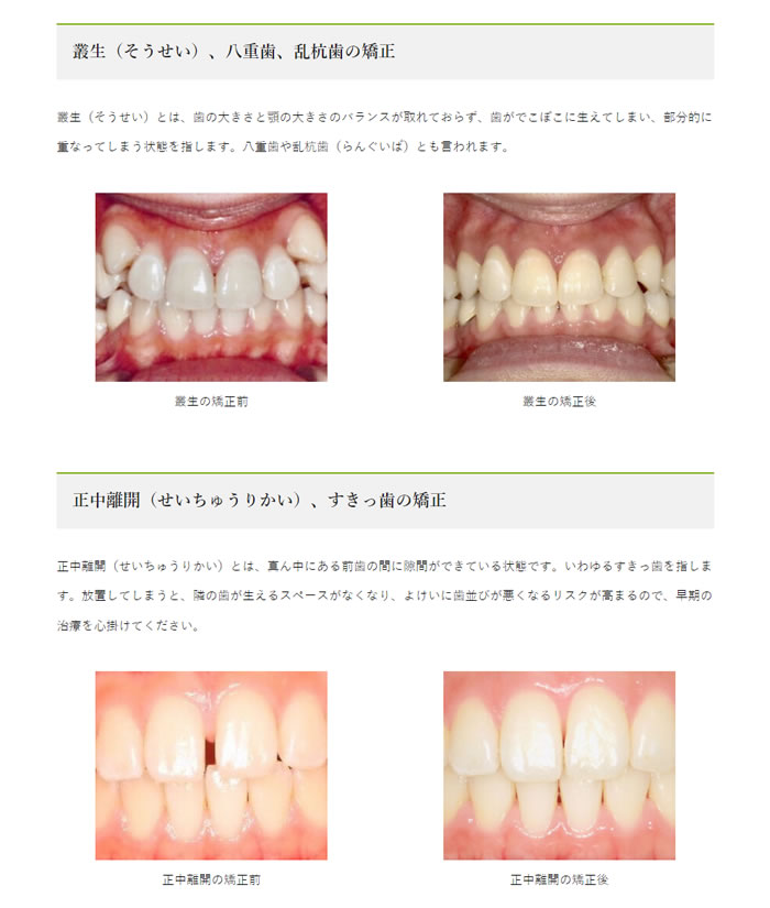 町田歯科の実際の矯正例