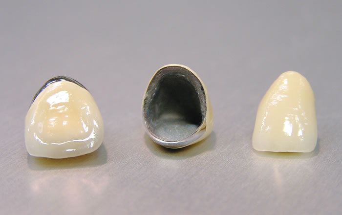 歯並び、咬み合わせが安定した状態で矮小歯の治療を