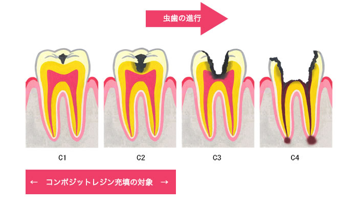 コンポジットレジン充填の適応となる虫歯は、C1～C2クラスの虫歯