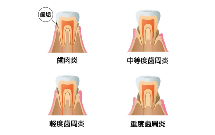 歯周病は進行度合いによってP1からP4までの4段階で評価