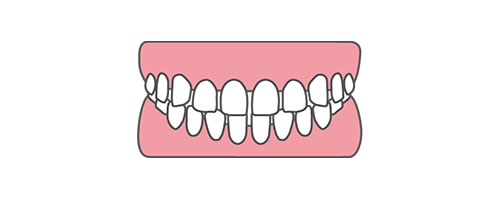 空隙歯列（くうげきしれつ）,すきっ歯
