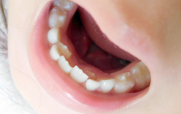 乳歯が抜けずに永久歯が生える