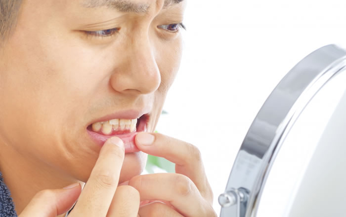 日本人の4人に1人は酸蝕歯、第三の歯科疾患