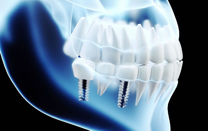 インプラントの噛み合わせが悪いとどんな影響が？…定期的な噛み合わせ