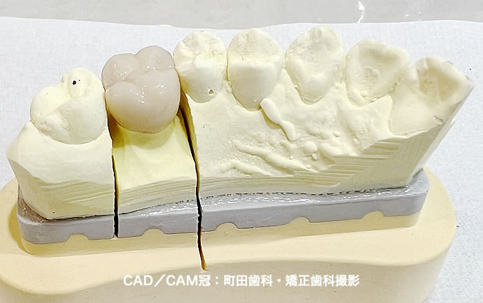 CAD／CAM冠：町田歯科・矯正歯科撮影
