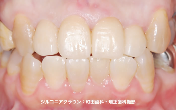 ジルコニアクラウンの適用例：町田歯科・矯正歯科撮影