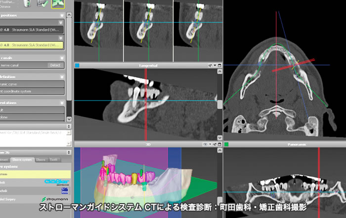 CTによる骨の状態の確認,ストローマンガイドシステム,町田歯科・矯正歯科撮影