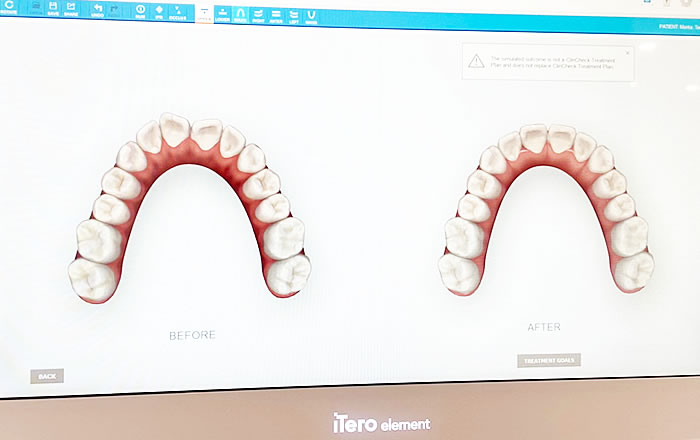 町田歯科では高性能3D口腔内スキャナiTeroを使用した、AIによる歯の移動シミュレーションを行います