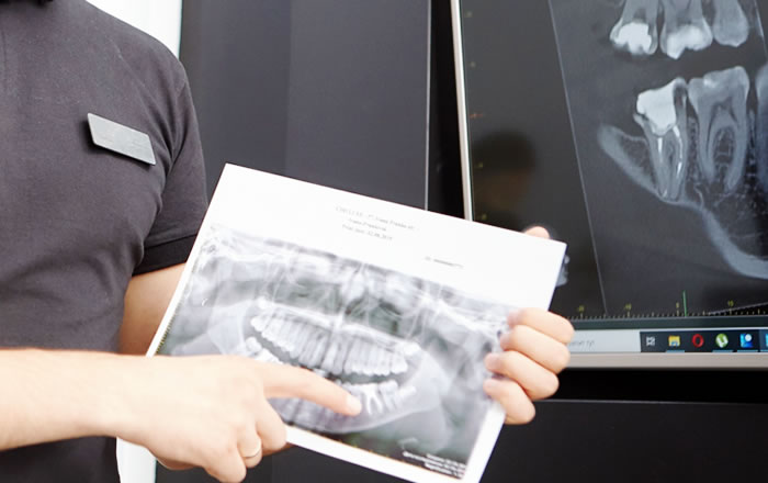 インプラント治療前のレントゲン検査,歯とその周囲の状態、噛み合わせの状態、顎の骨の状態などを確認します。
