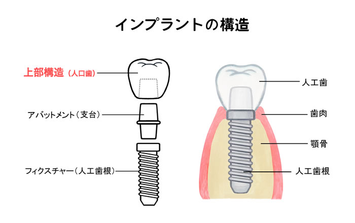 インプラントの審美性に大きく関わるのが、上部構造という歯冠部分