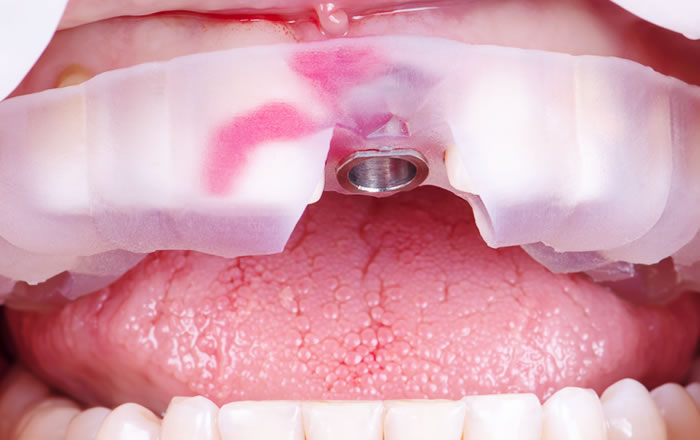 フラップレスのインプラント治療では、歯肉に小さな穴をあけてインプラントを埋入します