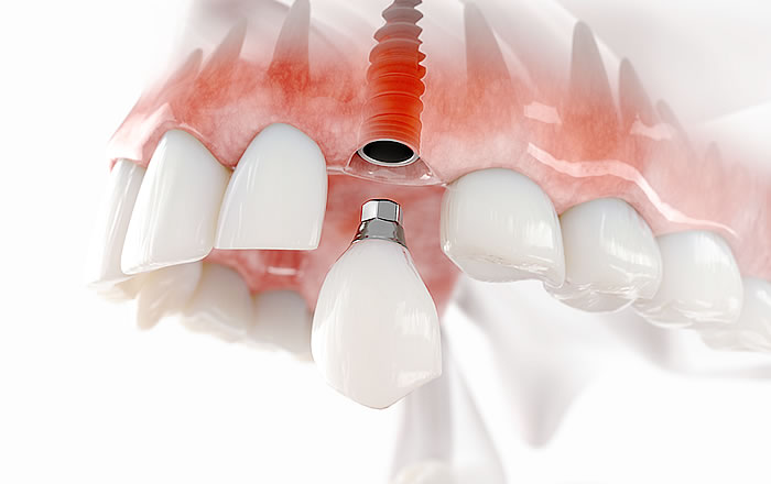犬歯を抜歯した後の治療：インプラント