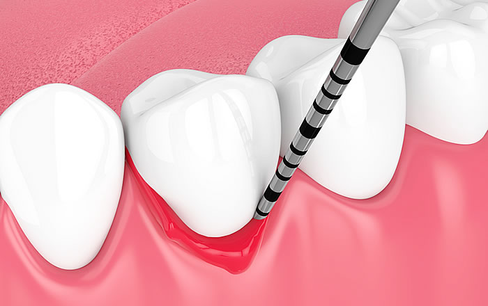 一般的な歯周病の歯肉炎に相当するのが、インプラント周囲粘膜炎です。インプラント周囲粘膜炎は、インプラント周辺の歯肉にだけ、腫れや赤み、痛み、出血などの炎症症状が生じます。