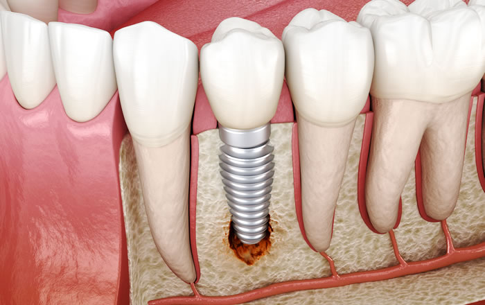 一般的な歯周病の歯周炎に相当するのがインプラント周囲炎です。インプラント周囲炎は、インプラントの周りの炎症が、歯肉から骨にまで広がった病態です。