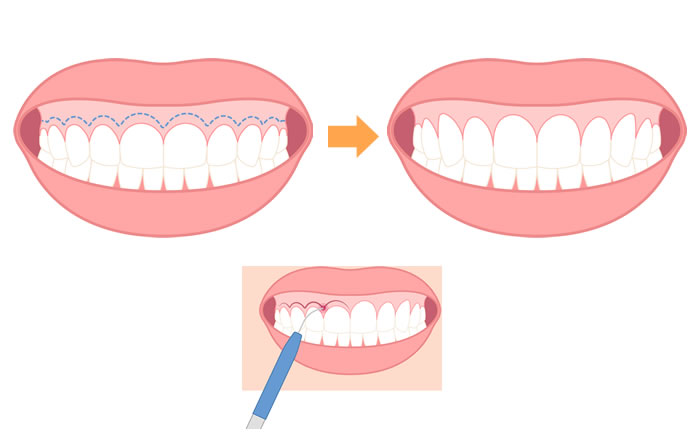 上顎前歯の長さが短いことによるガミースマイルの場合は、歯肉形成（歯肉を数ミリ切除する方法）を行い、歯冠の長さが適切になるようにします。