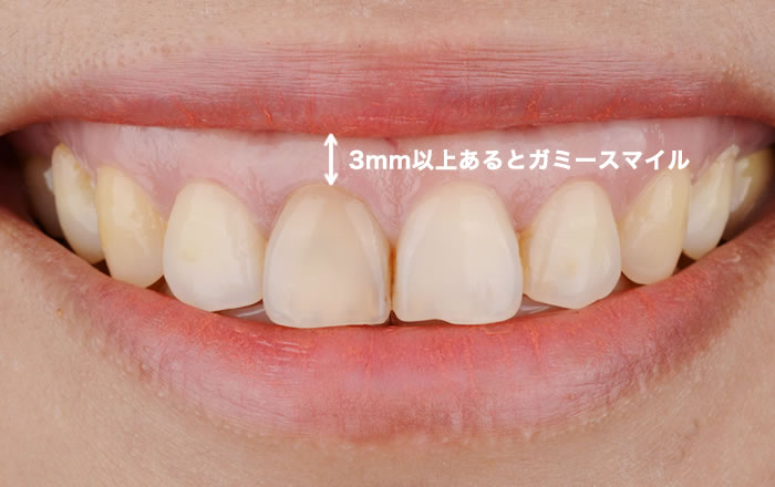 ガミースマイルの判定法,笑った時に上顎前歯の歯肉が3ミリ以上見えているとガミースマイル
