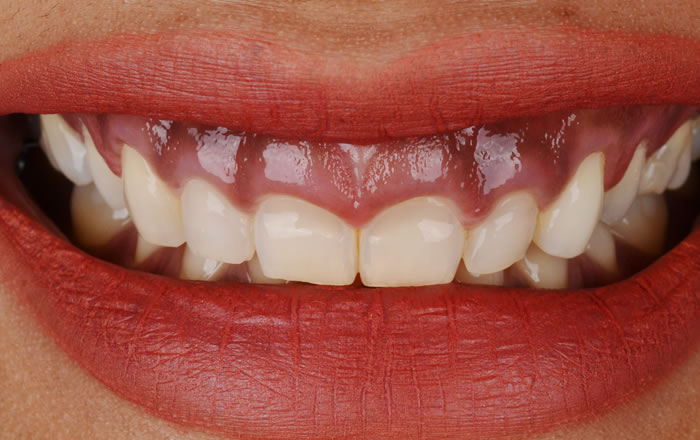 ガミースマイルの原因が歯肉増殖の場合