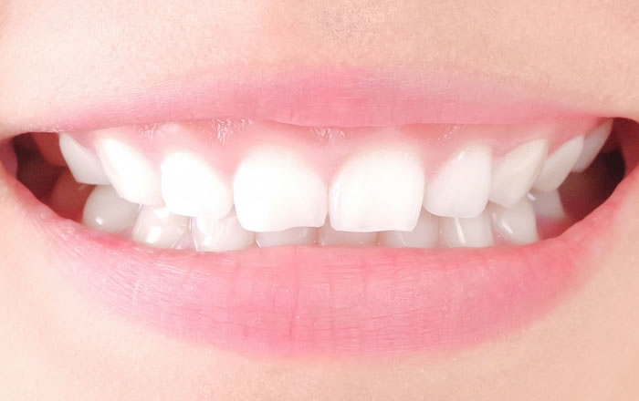 上顎前歯の長さが短い場合や、上顎前歯がすり減っている場合もガミースマイルになりやすくなります。