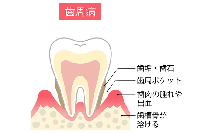 歯周病のメカニズム