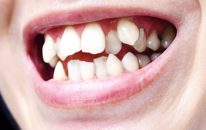 八重歯などは矯正治療を行い、基本的に犬歯は可能な限り残すように心がけます。