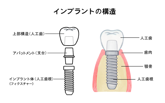 インプラントの構造