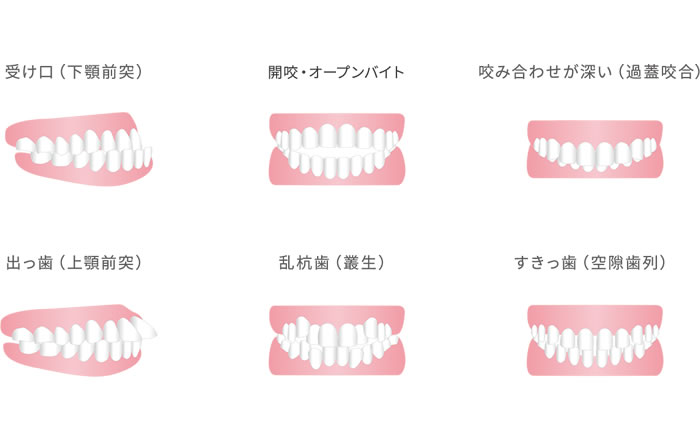 前歯が欠けたり折れたりする原因：歯列不正