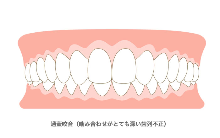 過蓋咬合（嚙み合わせがとても深い歯列不正）