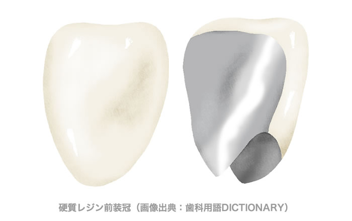 前歯が欠けたり折れたりした時の治療法：硬質レジン前装冠