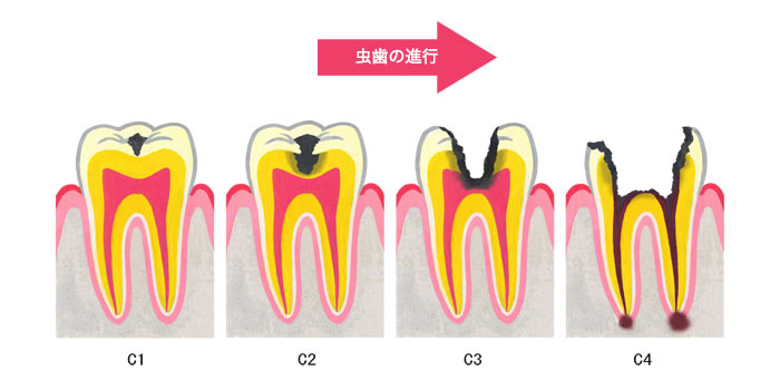 クラウンレングスニングとエクストリュージョンのデメリット：全ての歯に適応できるわけではない