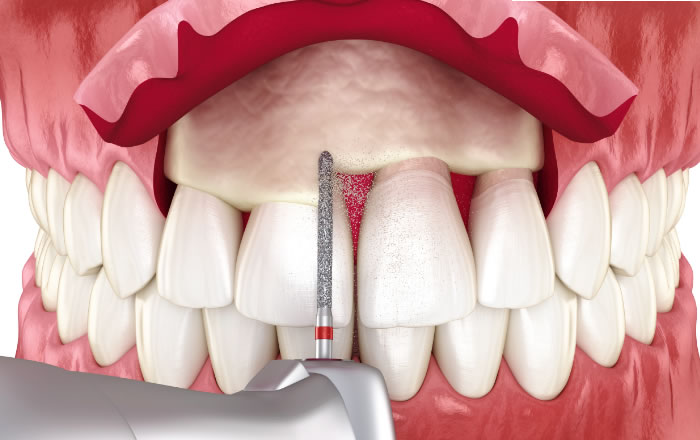 クラウンレングスニング（歯冠長延長術）とは？