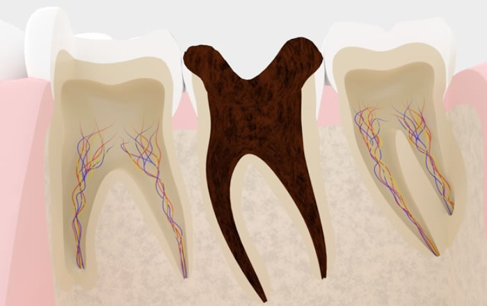 根管治療の後に痛みが出る原因：神経の取り残しによる痛み