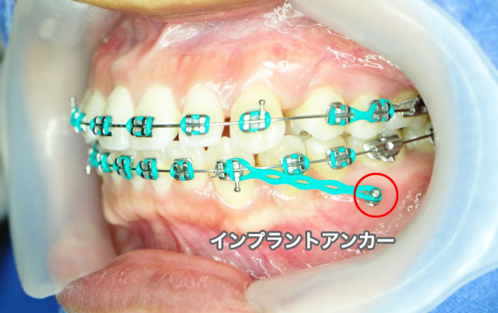 インプラントアンカー（TAD）、アンカースクリューとは