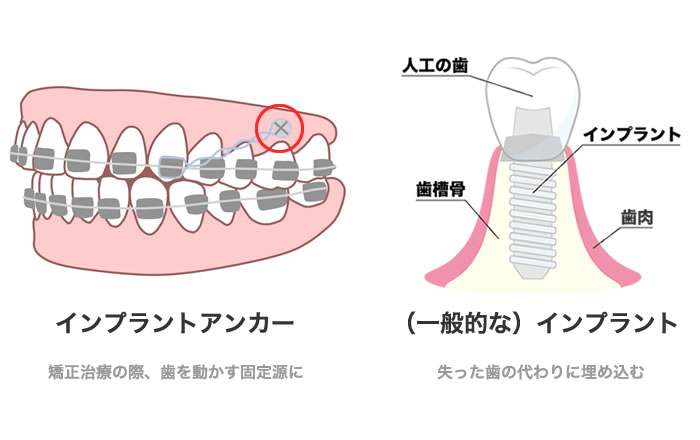 インプラントアンカーと通常のインプラントの違い