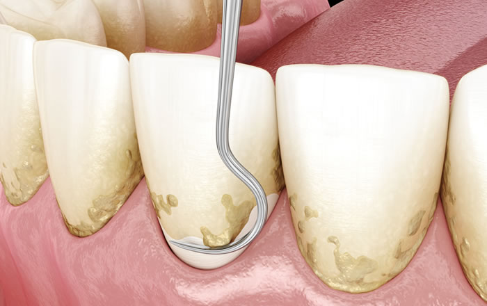 歯周病を放置すると治療回数が増える理由：歯石がたくさんついている