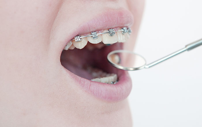 矯正治療の後戻りって何？