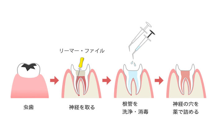 根管治療の流れ