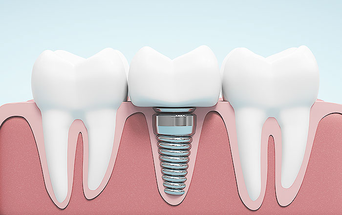インプラントの基本とも言えるオッセオインテグレーション | 町田駅