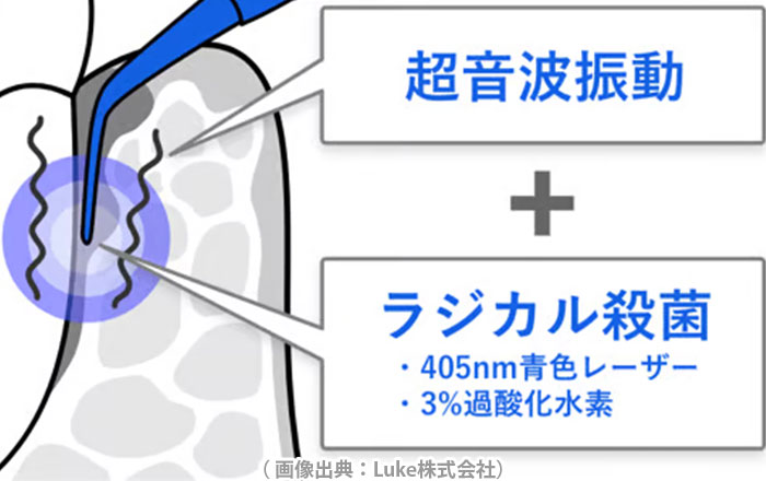 ブルーラジカル治療の流れ：歯周ポケット内のラジカル殺菌処置と超音波清掃