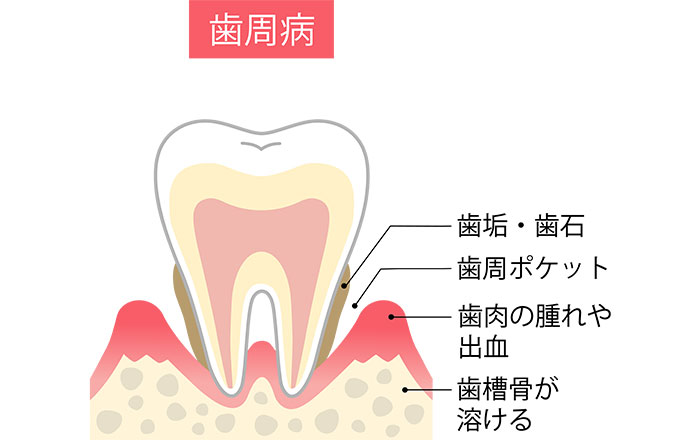 歯周病
