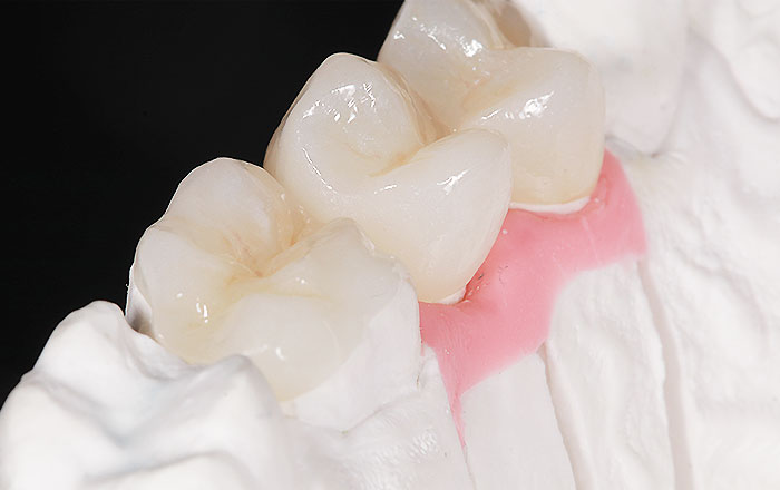 歯科医院で行う難聴・耳鳴りに対する3つのアプローチ：噛み合わせの調整