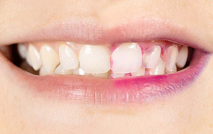 クラックトゥース症候群の検査法:クラック染色液による染め出し