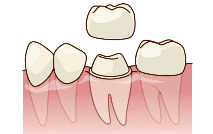 クラックトゥース症候群の治療法:歯の神経を残して被せ物をする