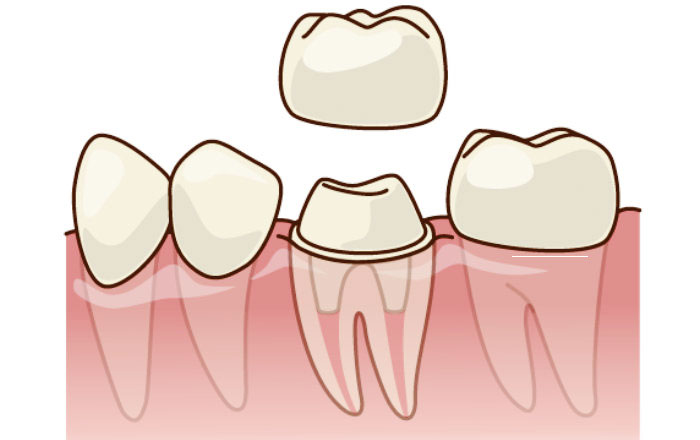 クラックトゥース症候群の治療法:歯の神経を取って被せ物をする