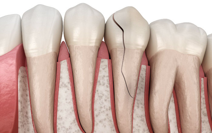 クラックトゥース症候群を放置するリスク~歯髄炎や歯根破折も