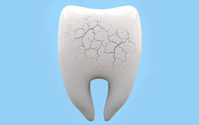クラックトゥース症候群とは、歯の表面にあるエナメル質や、その内側にある象牙質に、目には見えないほど微細なひび(マイクロクラック)が入ることで、痛みやしみるといった症状を引き起こす状態を指します。